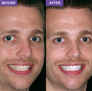 DR.PEARL™ Whitening Strips