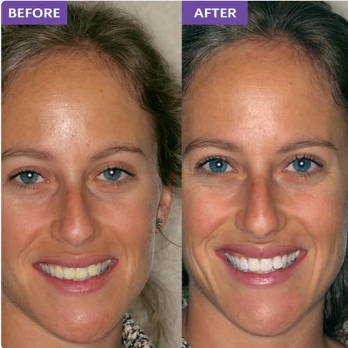 DR.PEARL™ Whitening Strips